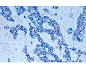 Tumor tissue section showing specific cytoplasmic cell staining (blue/gray, Vector SG) with Vector Nuclear Fast Red (red) counterstain.